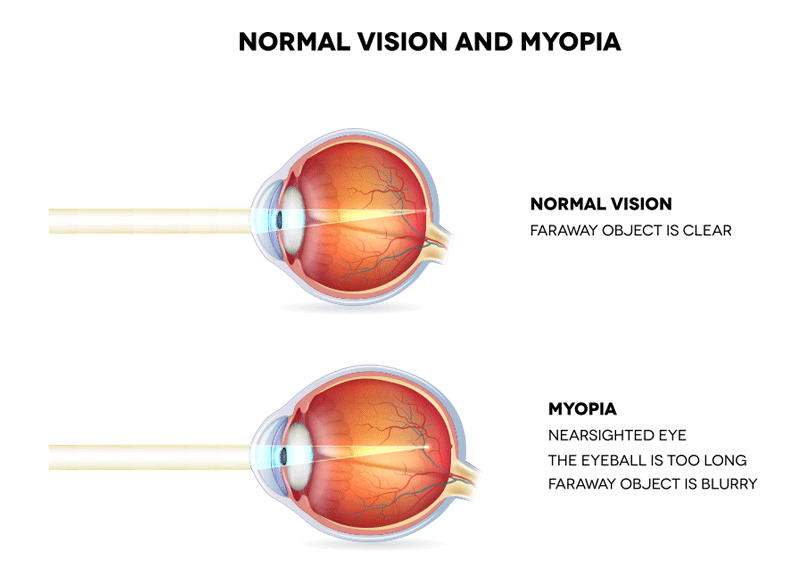 Eye anatomy - myopia and normal vision showing elongated eyeball in myopic eyes with inability to focus